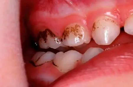 برای سلامت دندان ها اینها را بخور