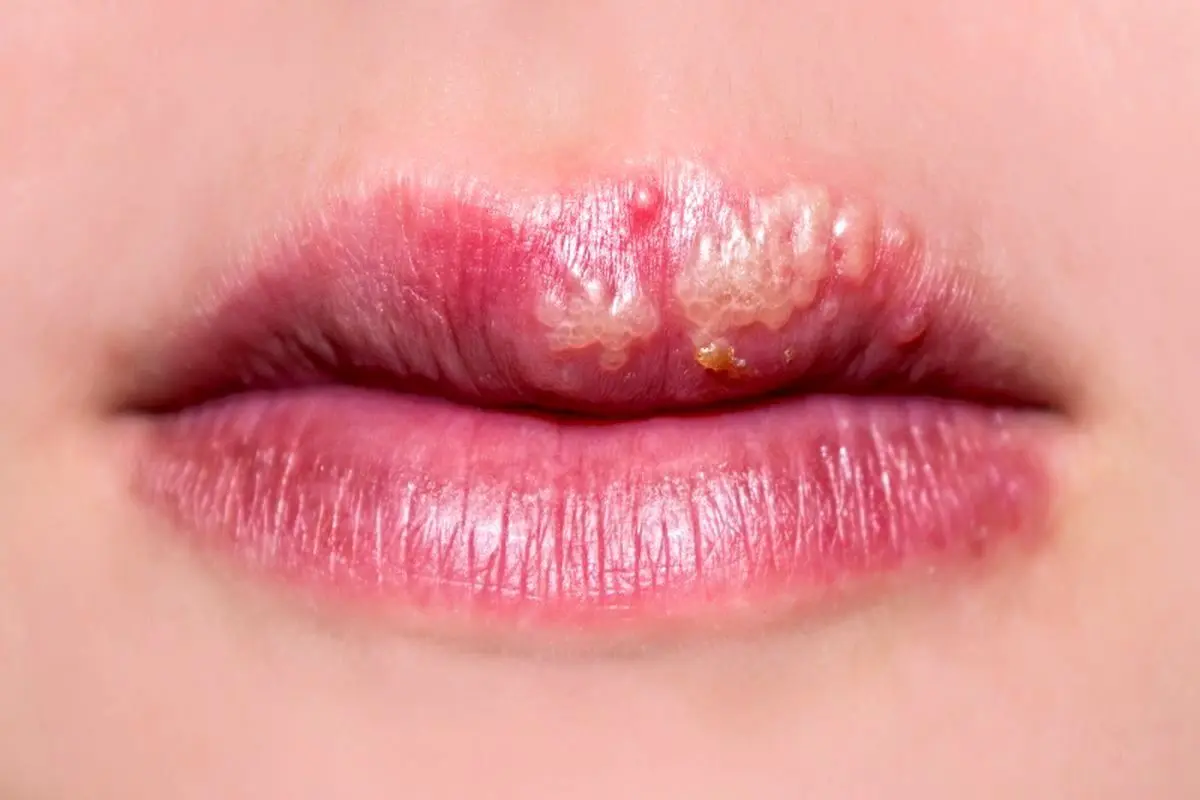 اشتباه مهلک در تشخیص آفت و تب‌خال؛ کدام‌یک مسری و خطرناک است؟