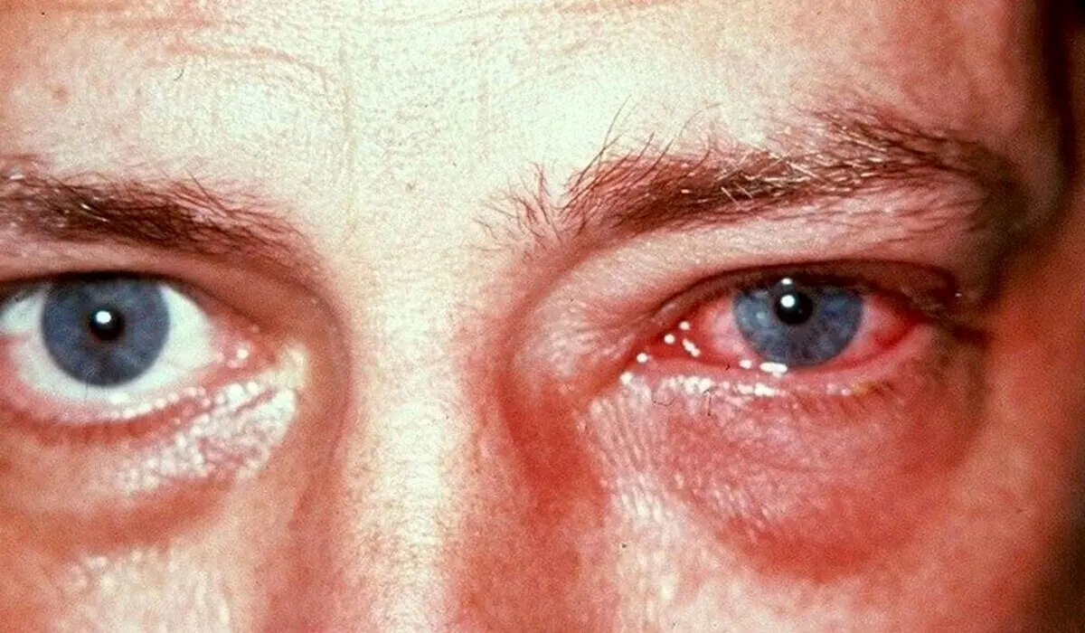 آلودگی هوا این بلا را سر چشم‌ها می‌آورد | مراقب باشید
