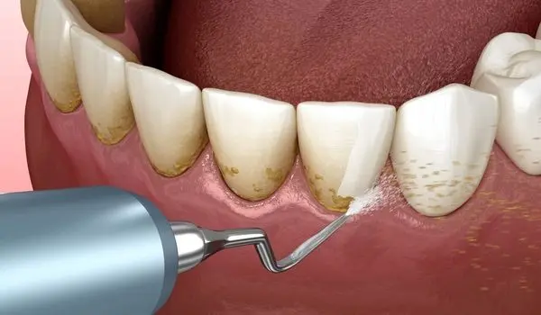 آیا جرمگیری به مینای دندان آسیب می زند؟
