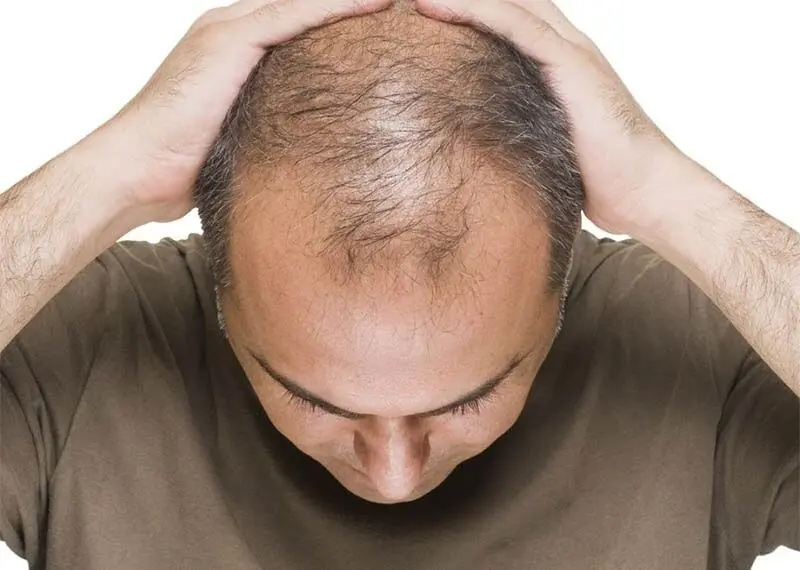  ریزش مو دارید و از طاس شدن می ترسید؟ این مطلب را بخوانید

