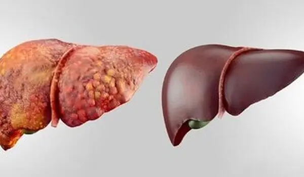 شایع‌ترین بیماری کبدی جهان چیست؟