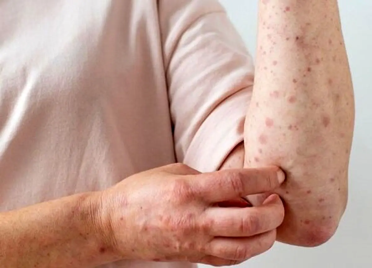 هشدار یک متخصص درباره شیوع بیماری عفونی در فصل بهار