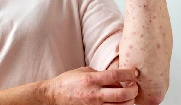 هشدار یک متخصص درباره شیوع بیماری عفونی در فصل بهار